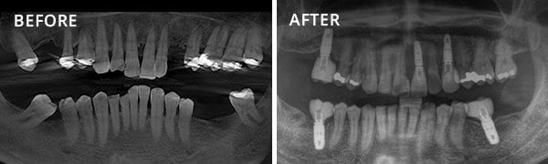 Dental Implants Poway Patient 3.2