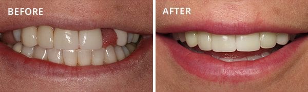 Dental Implants San Diego Patient 2