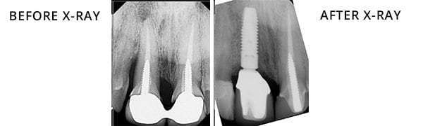 Dental Implants San Diego Patient 3.1