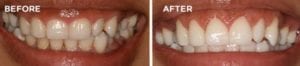 Before and After Gingival Recountering 1