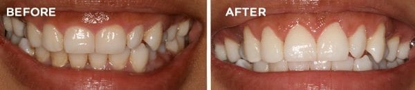 Before and After Gingival Recontouring 1