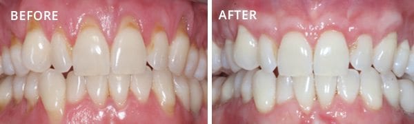 Gum contouring and gum grafts: before and after transformation