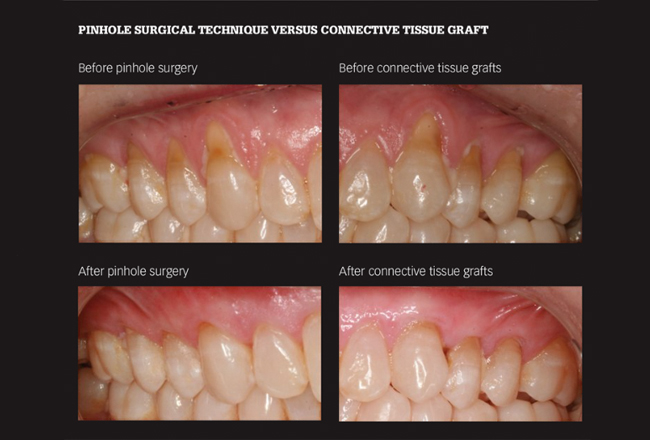 Pinhole Surgical Technique Gum Progression Collage