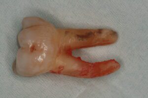 Dental Tartar on Tooth Root