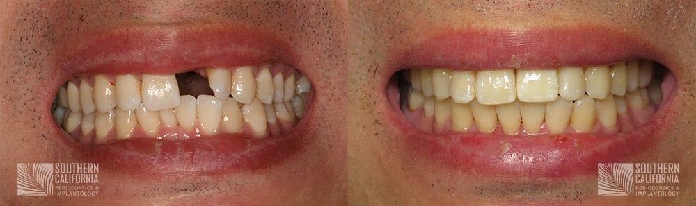 Before and After Dental Implants Patient 1