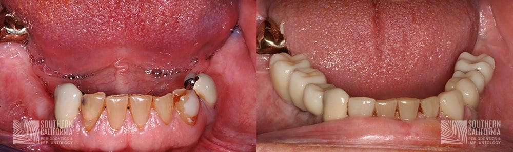 Before and After Dental Implants Patient 4