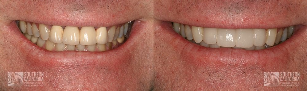 Before and After Dental Implants Patient 5a