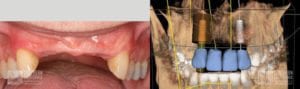 Before and After Dental Implants Patient 5c