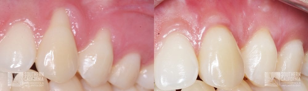 Before and After Gum Graft Patient 1