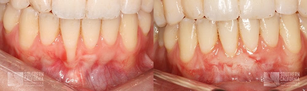 Before and After Gum Graft Patient 2