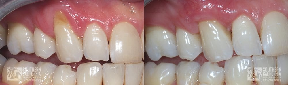 Before and After Gum Graft Patient 3
