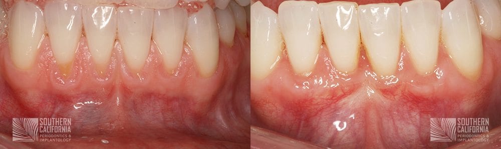 Before and After Gum Graft Patient 4
