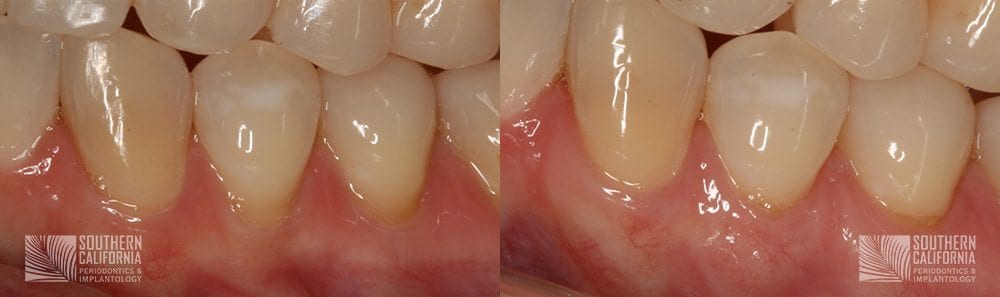 Before and After Gum Graft Patient 5