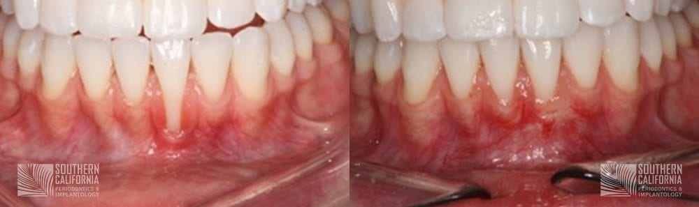 Before and After Gum Graft Patient 8