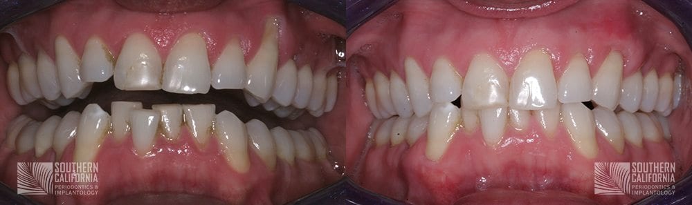 Before and After Gum Graft Patient 9a