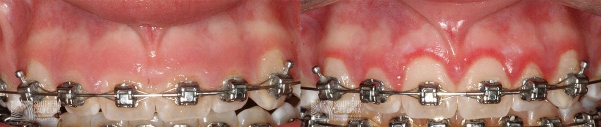 Before and After Crown Lengthening 2