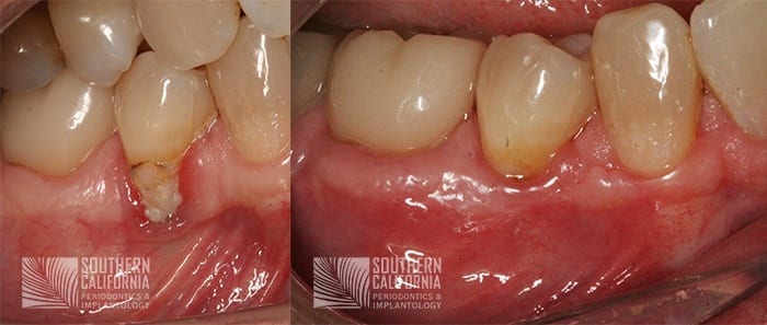 Before and After Gum Graft 10