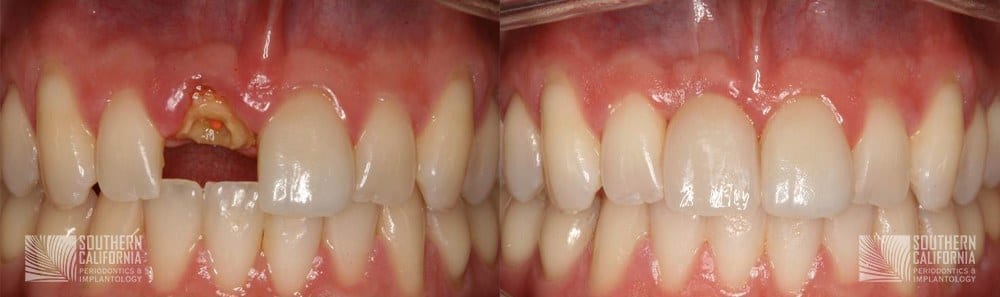 Before and After Dental Implants 10.1