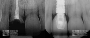 Before and After Dental Implants 10.2