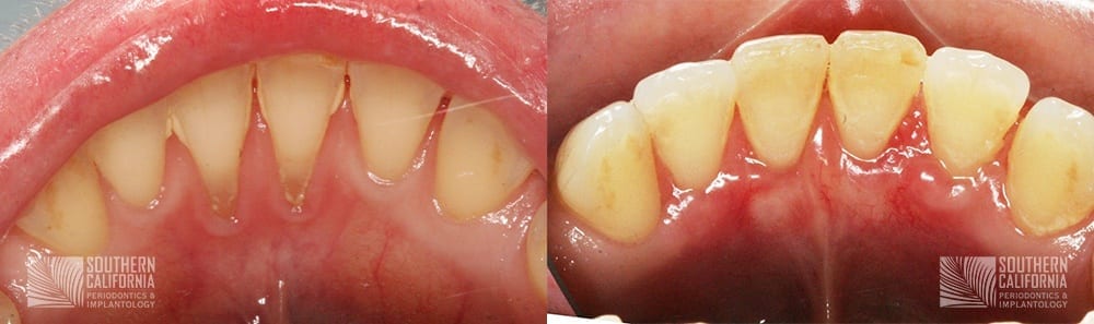 Before and After Tissue Graft 11