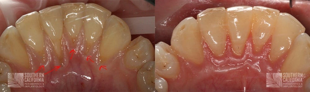 Before and After Tissue Graft 12