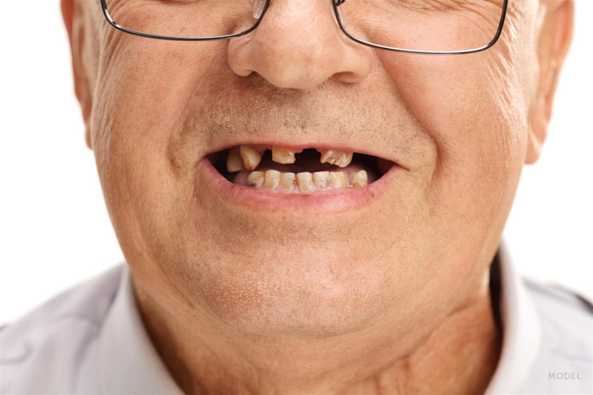 Close Up of Old Man with Missing and Chipped Teeth