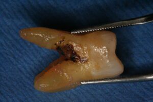 dental calculus on tooth root